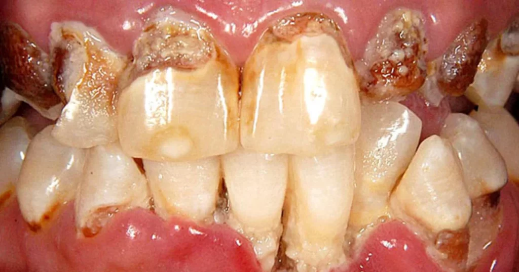 عوارض ماده مخدر شیشه روی دندان